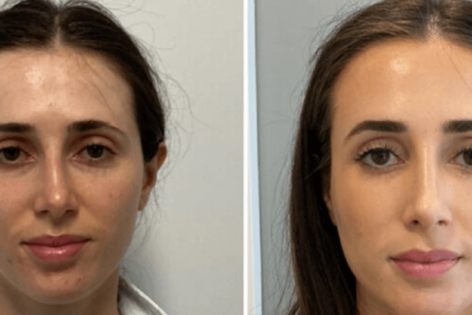 Enhancing Beauty and Functionality: A Comprehensive Guide to Rhinoplasty in Sydney