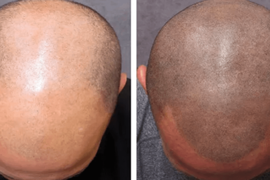 Unlock Your Confidence: The Transformative Power of Scalp Micropigmentation at HairTattoo.ca